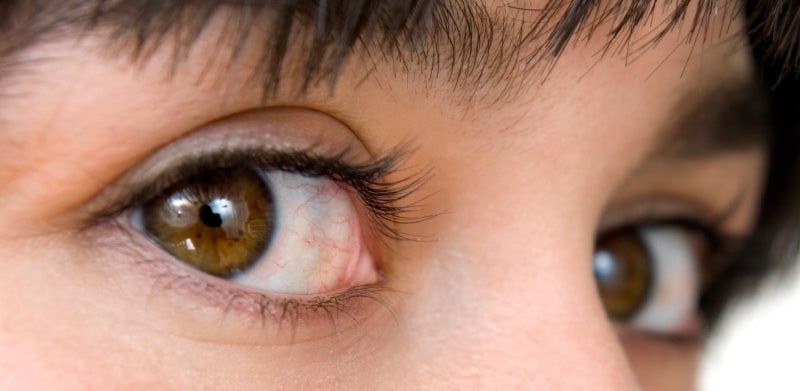 Overwearing contact lenses: red eye treatment