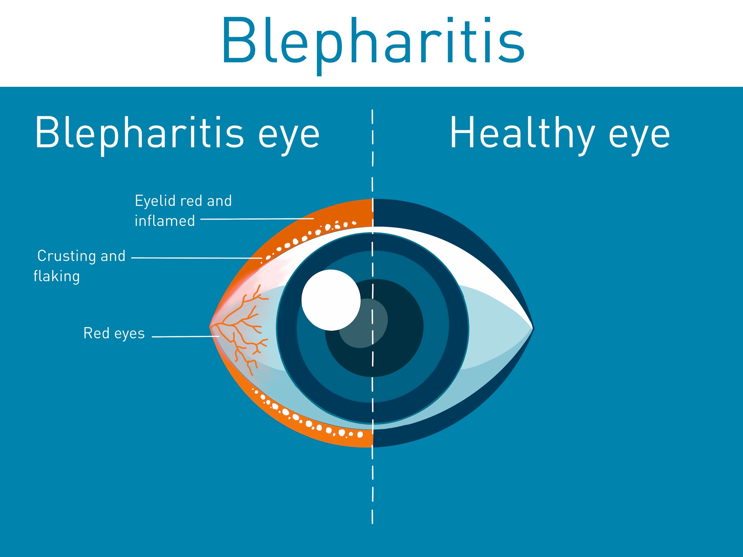 Blepharitis